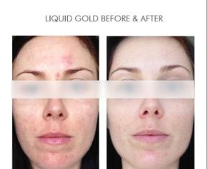 Жидкое золото. Пилинг Alpha-H Liquid Gold3 Жидкое золото. Пилинг Alpha-H Liquid Gold