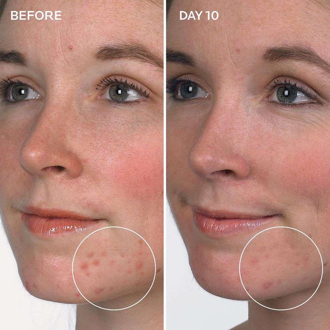 La Roche-Posay USA - Real skin, real results of our #Effaclar Duo Acne Spot Treatment ✨💙⁣
⁣
Our best spot treatment for acne is formulated with key ingredients to provide fast and visible results in l...