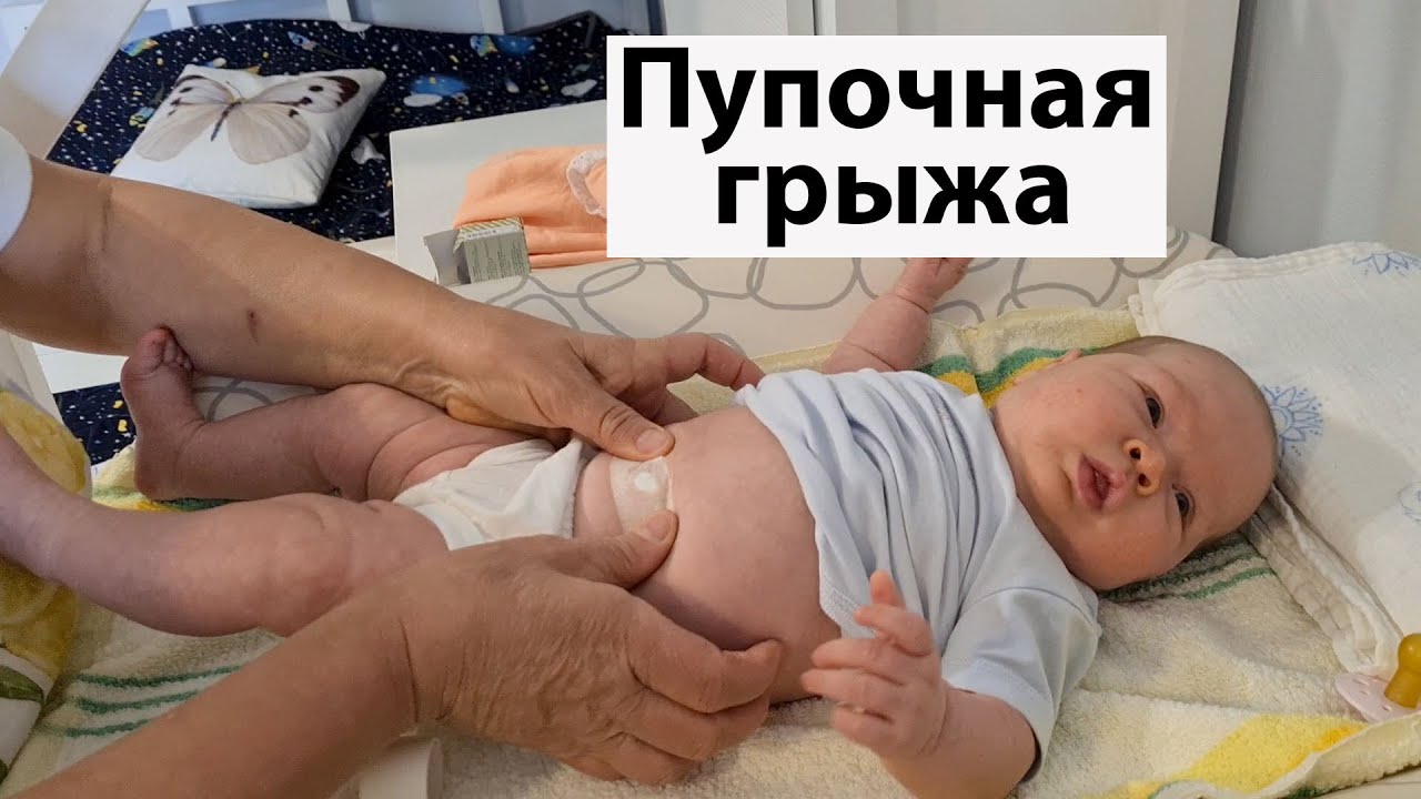 VLOG: Пупочная грыжа, как лечить