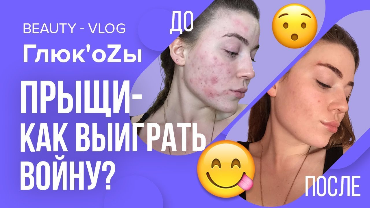 Глюк'oZa Beauty Vlog: Прыщи / Как избавиться навсегда от акне