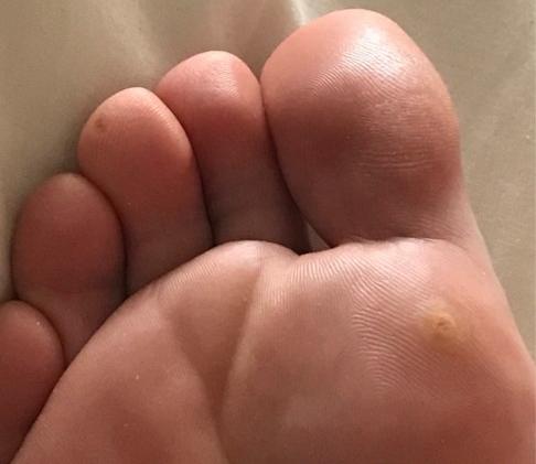 Здесь хорошо видно обе: на пальце поменьше и на стопе побольше. Появились с разницей в пару недель