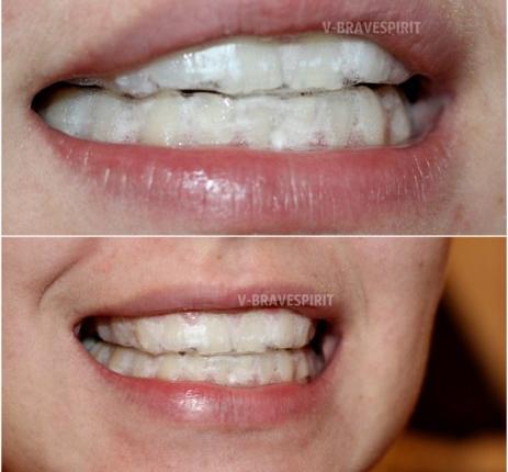 После отбеливания зубов остались белые пятна щетка детская колгейт электрическая зубная отзывы